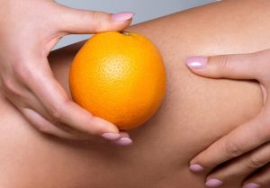 درمان سلولیت با تغذیه و ورزش